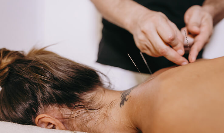  Acupuntura